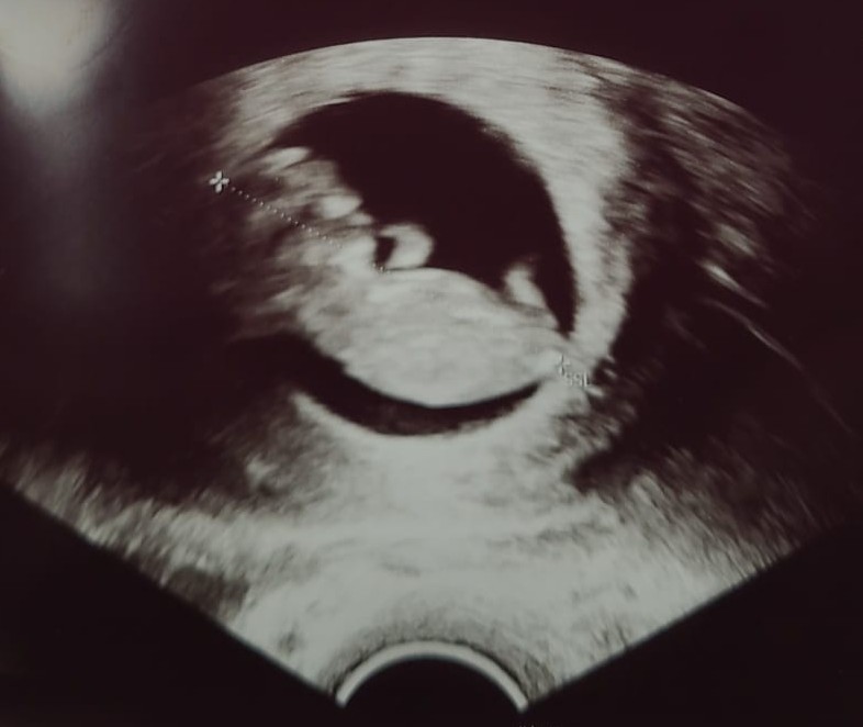 12-week ultrasound scan